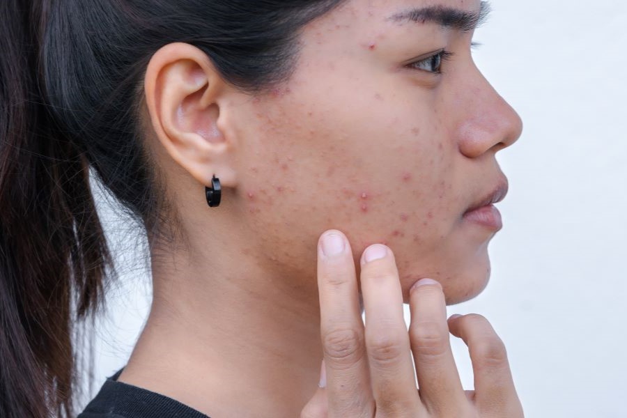Side profile of woman with hormonal acne across face